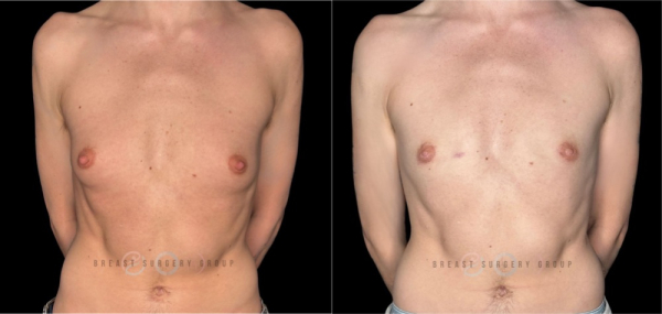 10558-female-to-male-n-top-surgery-periareolar-technique-before-after-photo-nyc