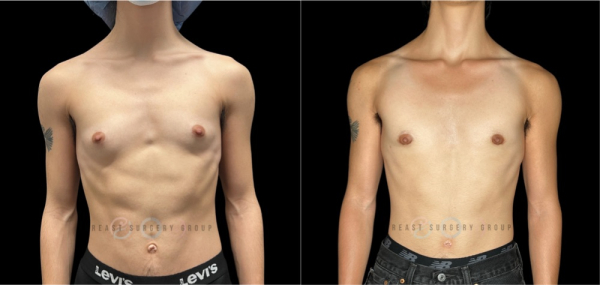 periareolar-female-to-male-n-top-surgery-before-after-photo-nyc-1-1