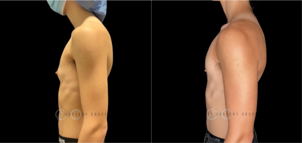 periareolar-female-to-male-n-top-surgery-before-after-photo-nyc-1-2