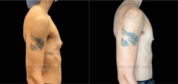 periareolar-female-to-male-n-top-surgery-before-after-photo-nyc-1-3
