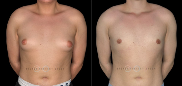 11480-top-surgery-ftm-periareolar-technique-plastic-surgery-before-and-after-photo-1