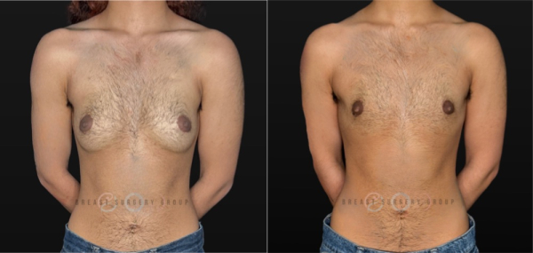 11794-top-surgery-ftm-periareolar-technique-plastic-surgery-before-and-after-photo-1