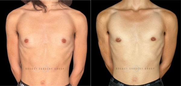 8743-female-to-male-n-top-surgery-periareolar-technique-before-after-photo-nyc