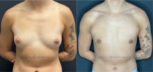 9226-female-to-male-n-top-surgery-periareolar-technique-before-after-photo-nyc