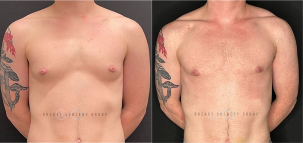 female-to-male-n-top-surgery-periareolar-technique-before-after-photo-nyc-2