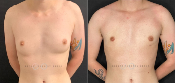 female-to-male-n-top-surgery-periareolar-technique-before-after-photo-nyc-3