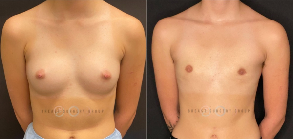 female-to-male-n-top-surgery-periareolar-technique-before-after-photo-nyc-4