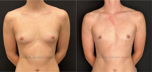 female-to-male-n-top-surgery-periareolar-technique-before-after-photo-nyc-5