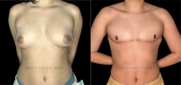 10053-female-to-male-n-top-surgery-double-incision-technique-before-after-photo-nyc