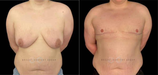 10196-top-surgery-ftm-double-incision-technique-plastic-surgery-before-and-after-photo-1