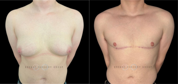 10286-female-to-male-n-top-surgery-double-incision-technique-before-after-photo-nyc