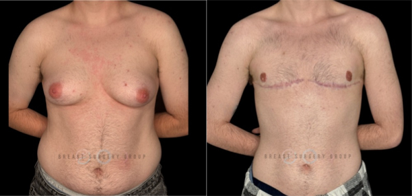 10327-female-to-male-n-top-surgery-double-incision-technique-before-after-photo-nyc