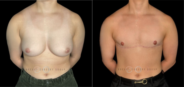 10339-top-surgery-ftm-double-incision-technique-plastic-surgery-before-and-after-photo-1