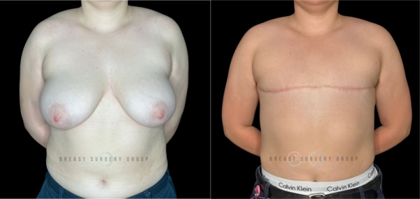 10510-female-to-male-n-top-surgery-double-incision-technique-before-after-photo-nyc