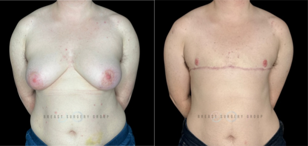 10686-female-to-male-n-top-surgery-double-incision-technique-before-after-photo-nyc