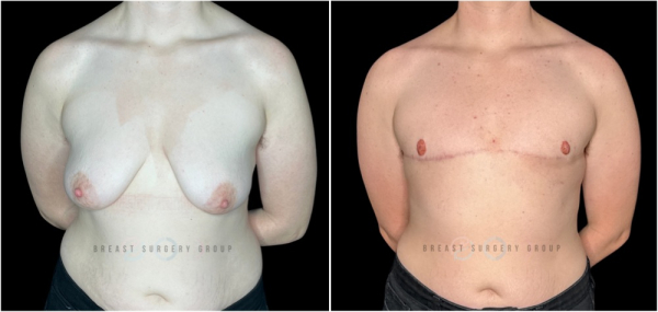 10729-top-surgery-gender-affirming-radical-breast-reduction-double-incision