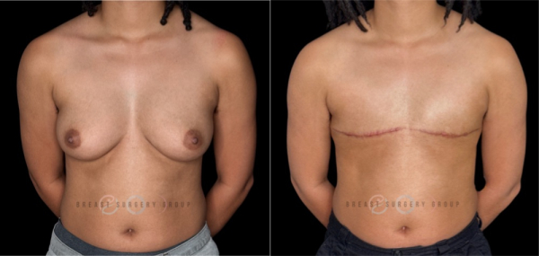 10886-top-surgery-ftm-double-incision-technique-plastic-surgery-before-and-after-photo-1