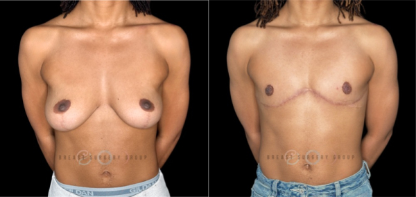 10942-top-surgery-ftm-double-incision-technique-plastic-surgery-before-and-after-photo-1