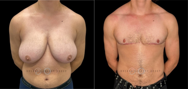 10956-top-surgery-ftm-double-incision-technique-plastic-surgery-before-and-after-photo-1