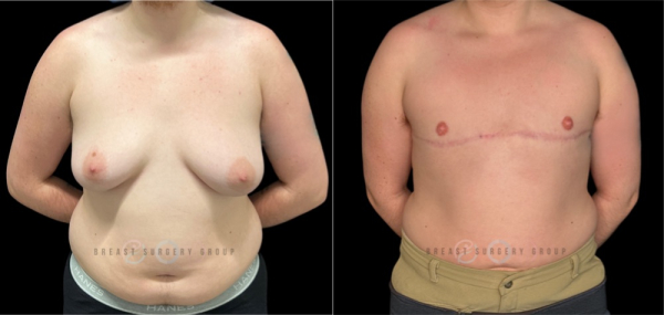 11099-female-to-male-n-top-surgery-double-incision-technique-before-after-photo-nyc