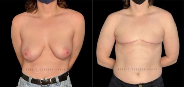11419-top-surgery-ftm-double-incision-technique-plastic-surgery-before-and-after-photo-1