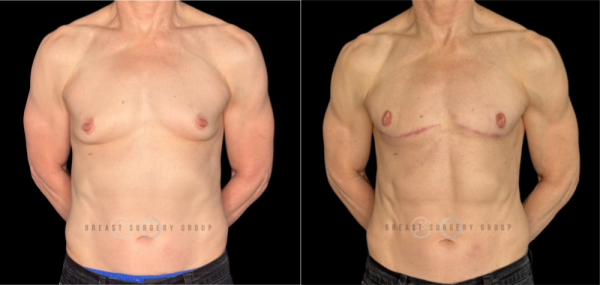 11684-female-to-male-n-top-surgery-double-incision-technique-before-after-photo-nyc