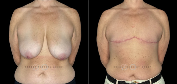 11763-top-surgery-ftm-double-incision-technique-plastic-surgery-before-and-after-photo-1
