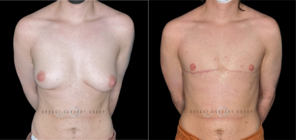 11817-top-surgery-ftm-double-incision-technique-plastic-surgery-before-and-after-photo-1