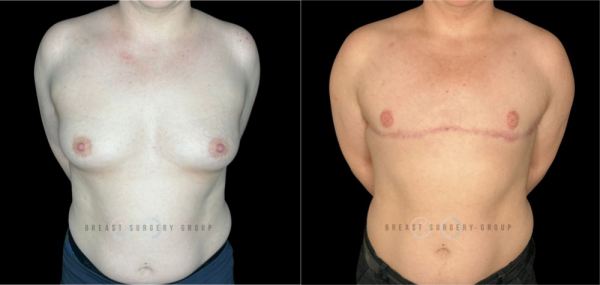 6768-female-to-male-n-top-surgery-double-incision-technique-before-after-photo-nyc