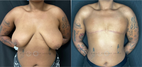 8456-female-to-male-n-top-surgery-double-incision-technique-before-after-photo-nyc