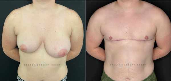 9796-female-to-male-n-top-surgery-double-incision-technique-before-after-photo-nyc