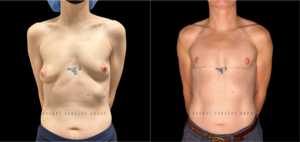 female-to-male-n-top-surgery-double-incision-technique-before-after-photo-nyc-1