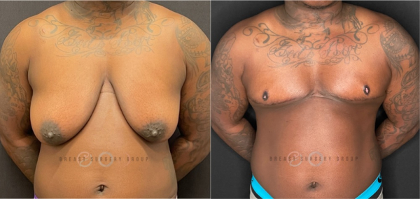 female-to-male-n-top-surgery-double-incision-technique-before-after-photo-nyc-10