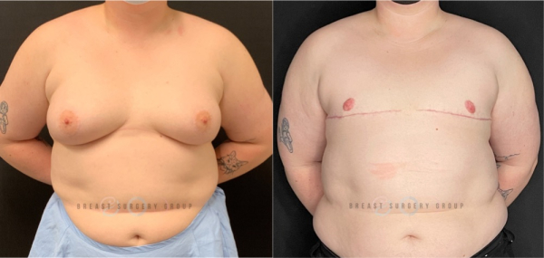 female-to-male-n-top-surgery-double-incision-technique-before-after-photo-nyc-11