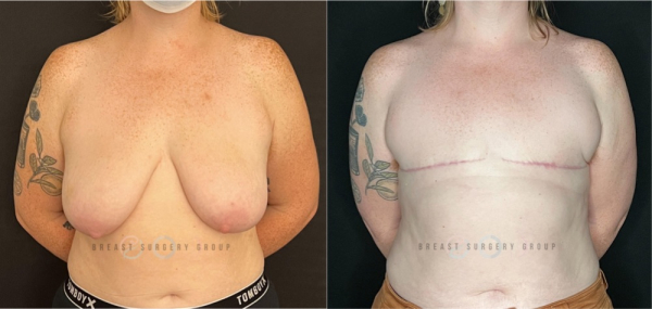 female-to-male-n-top-surgery-double-incision-technique-before-after-photo-nyc-12