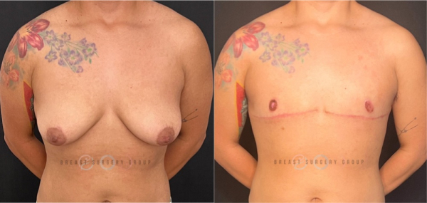 female-to-male-n-top-surgery-double-incision-technique-before-after-photo-nyc-13
