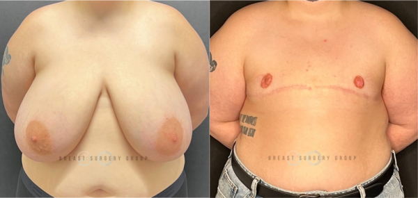 female-to-male-n-top-surgery-double-incision-technique-before-after-photo-nyc-14