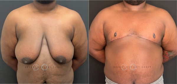 female-to-male-n-top-surgery-double-incision-technique-before-after-photo-nyc-15