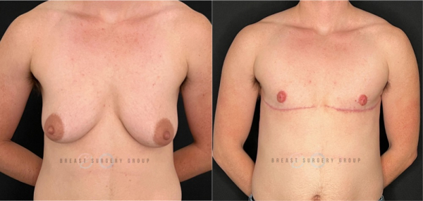 female-to-male-n-top-surgery-double-incision-technique-before-after-photo-nyc-16