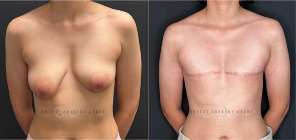 female-to-male-n-top-surgery-double-incision-technique-before-after-photo-nyc-17