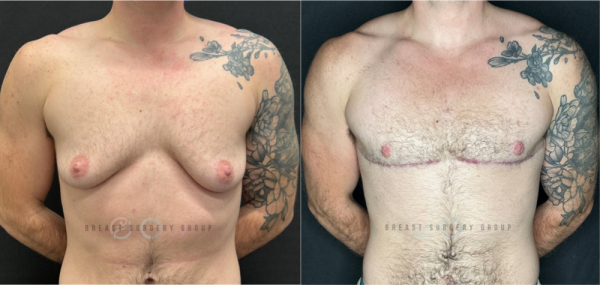 female-to-male-n-top-surgery-double-incision-technique-before-after-photo-nyc-18
