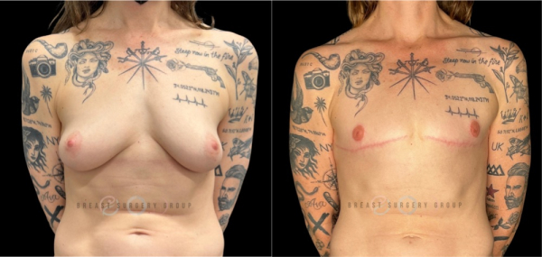 female-to-male-n-top-surgery-double-incision-technique-before-after-photo-nyc-2