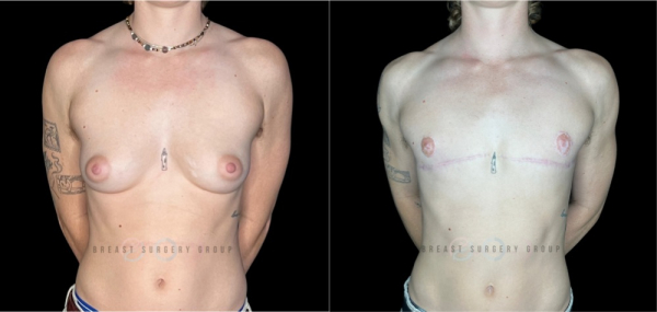 female-to-male-n-top-surgery-double-incision-technique-before-after-photo-nyc-3