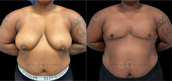 female-to-male-n-top-surgery-double-incision-technique-before-after-photo-nyc-4