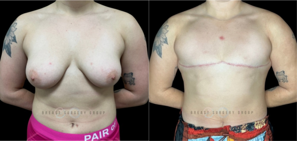 female-to-male-n-top-surgery-double-incision-technique-before-after-photo-nyc-5