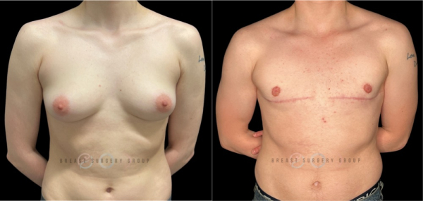 female-to-male-n-top-surgery-double-incision-technique-before-after-photo-nyc-6