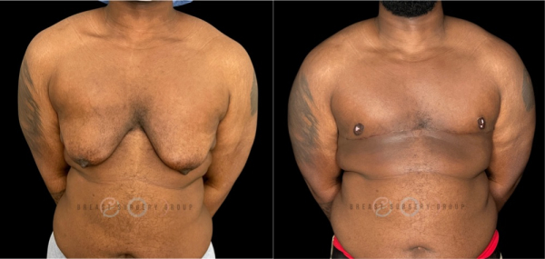 female-to-male-n-top-surgery-double-incision-technique-before-after-photo-nyc-7