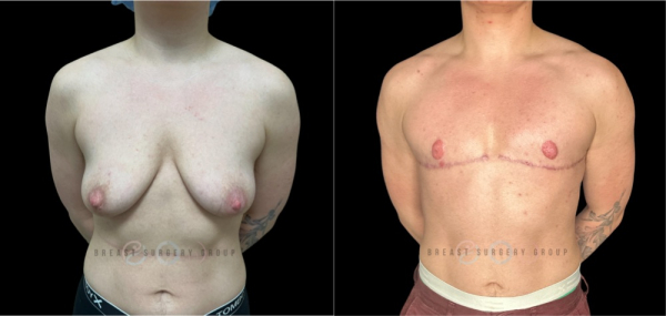 female-to-male-n-top-surgery-double-incision-technique-before-after-photo-nyc-9