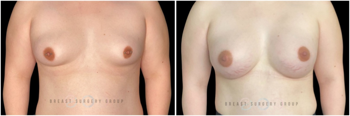 male-to-female-n-top-surgery-before-after-photo-nyc-kb-1-1