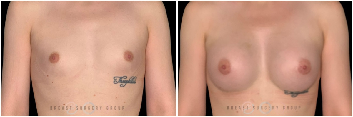 male-to-female-n-top-surgery-before-after-photo-nyc-kb-1-2